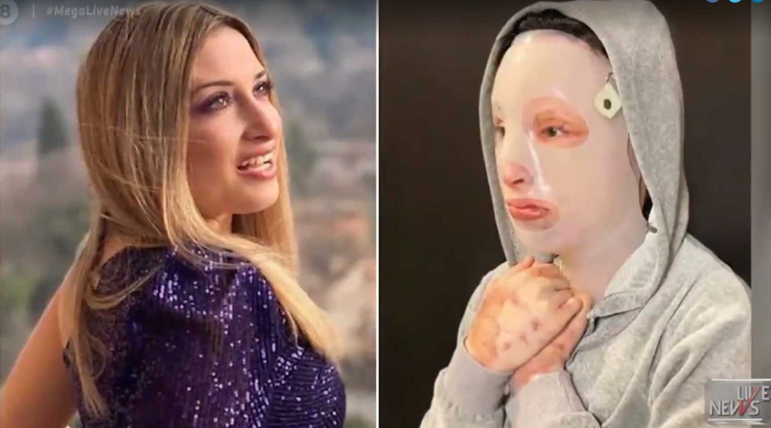 Επίθεση με βιτριόλι - Συγκλονίζει η Ιωάννα στην πρώτη τηλεοπτική της συνέντευξη-Βίντεο